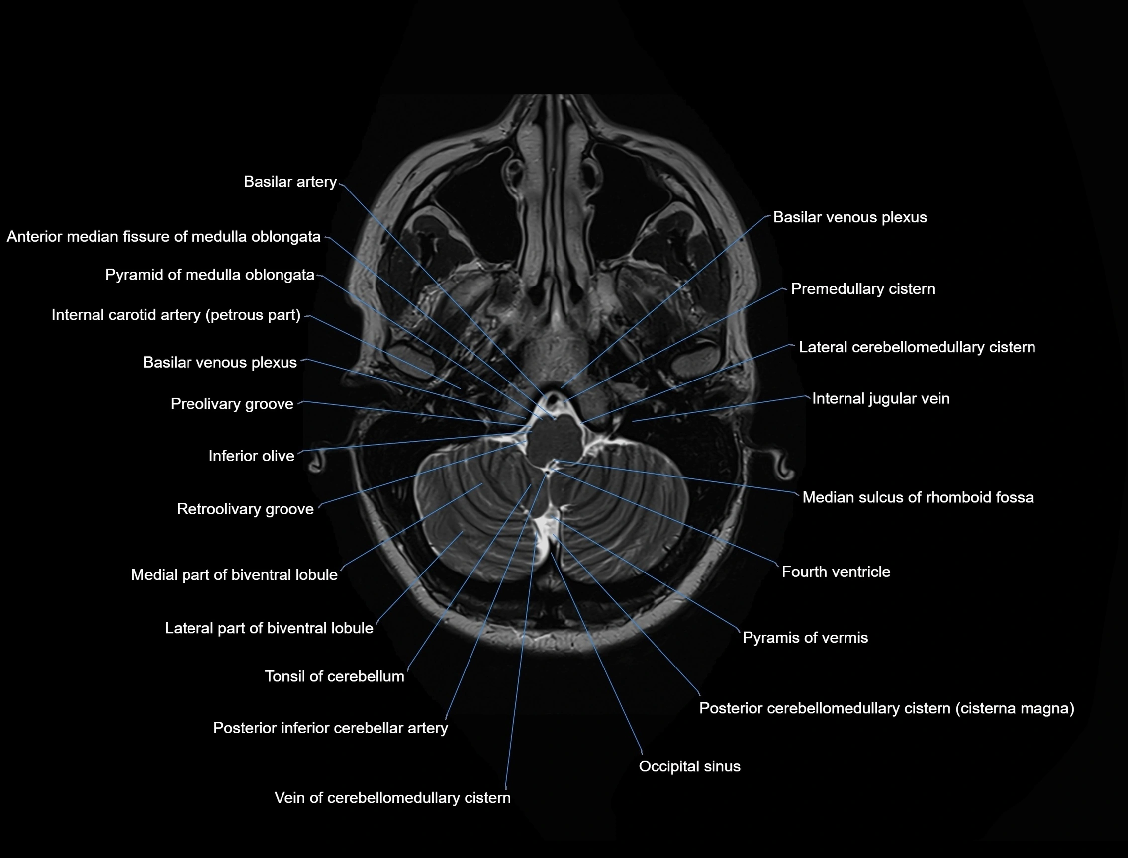 MRI Brain axial cross sectional radiology anatomy 3T image  -img-00001-00008.webp